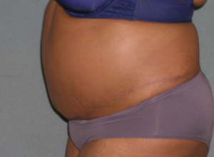 Tummy Tuck Before and After Photos