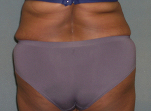 Tummy Tuck Before and After Photos