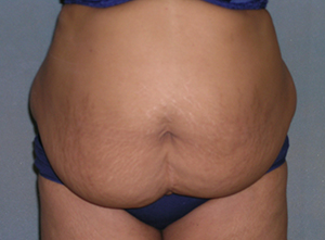 Tummy Tuck Before and After Photos