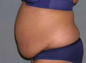 Tummy Tuck Before and After Photos