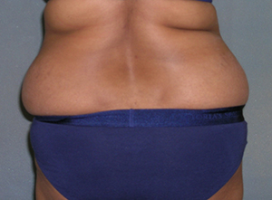 Tummy Tuck Before and After Photos
