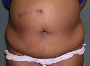 Tummy Tuck Before and After Photos