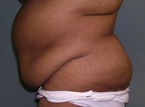 Tummy Tuck Before and After Photos