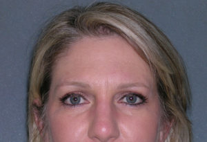 Blepharoplasty Case 5071 After Photo Blepharoplasty