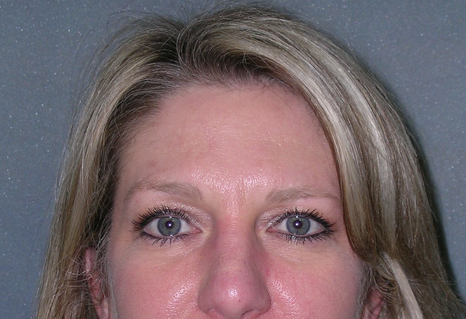 Blepharoplasty Before and After Photos