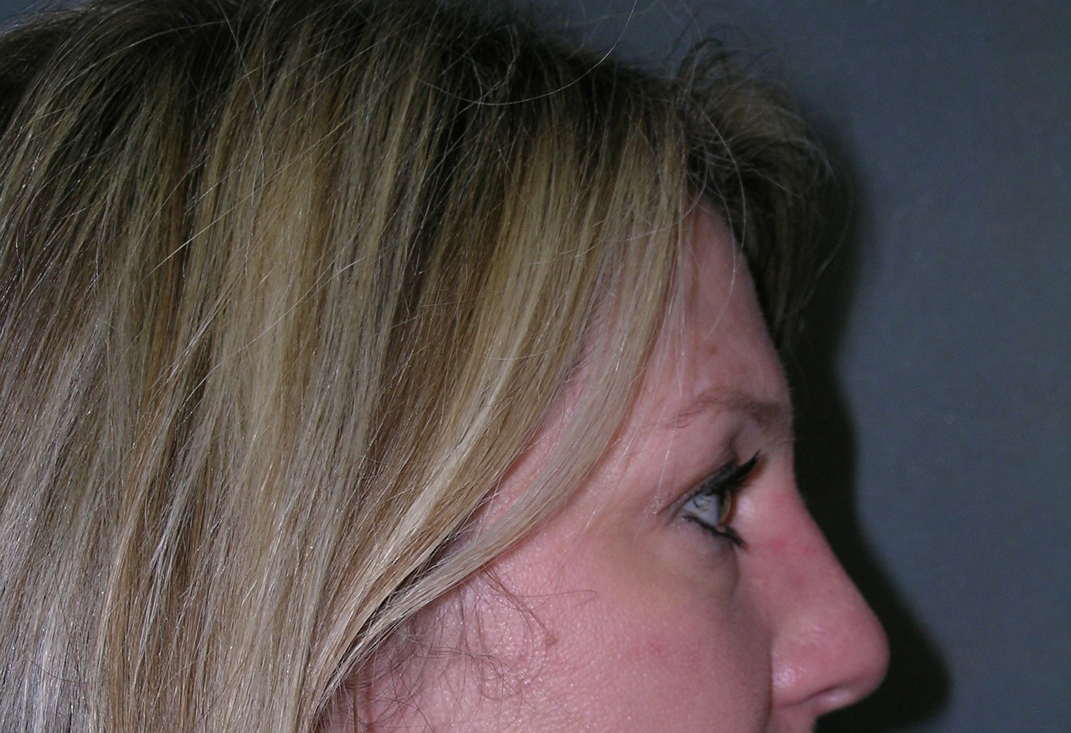 Endoscopic Forehead Lift Before and After Photos Case 5078