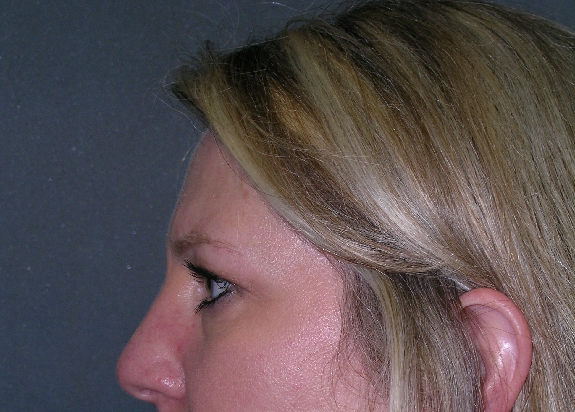 Endoscopic Forehead Lift Before and After Photos Case 5078