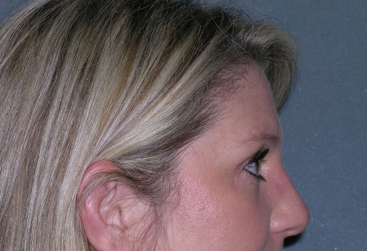 Endoscopic Forehead Lift Before and After Photos Case 5078