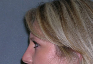 Endoscopic Forehead Lift Case 5078 After Photo Endoscopic Forehead Lift
