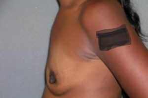Augmentation Mammoplasty Case 5085 Before Photo Augmentation Mammoplasty