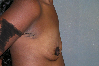 Augmentation Mammoplasty Before and After Photos