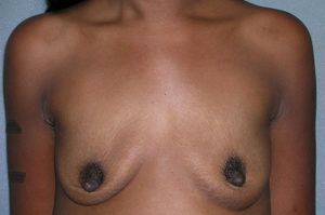 Augmentation Mammoplasty Case 5085 Before Photo Augmentation Mammoplasty