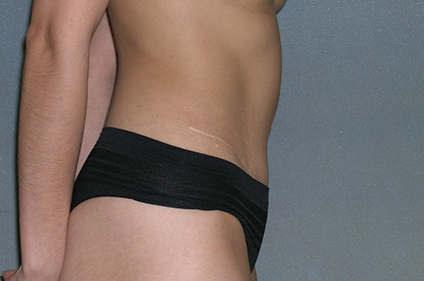 Augmentation Mammoplasty Before and After Photos