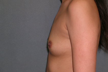 Augmentation Mammoplasty Before and After Photos