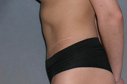 Augmentation Mammoplasty Before and After Photos