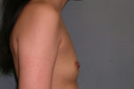 Augmentation Mammoplasty