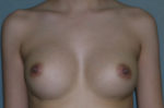 Augmentation Mammoplasty