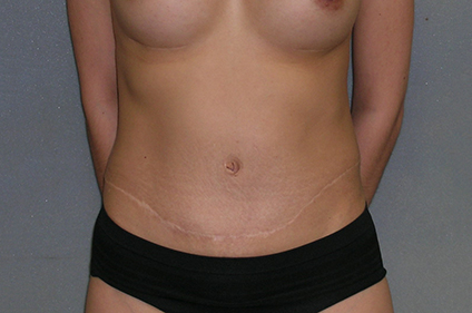 Augmentation Mammoplasty Before and After Photos