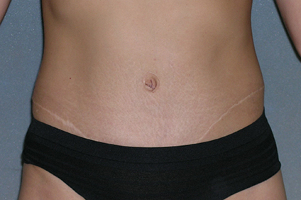 Tummy Tuck Before and After Photos