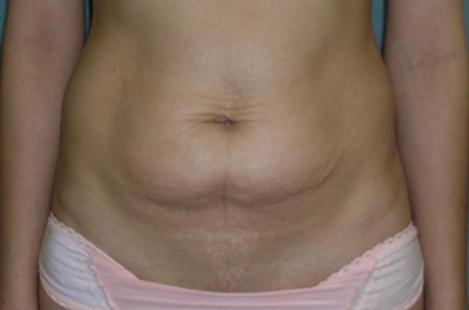 Tummy Tuck Before and After Photos