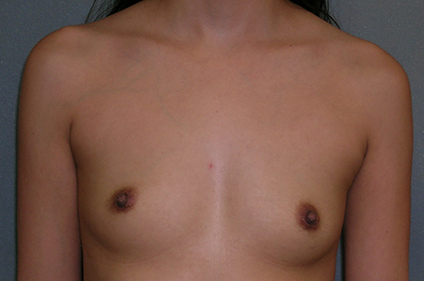 Breast and Abdomen Before and After Photos