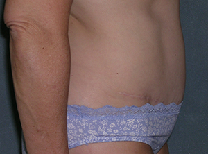 Tummy Tuck Before and After Photos