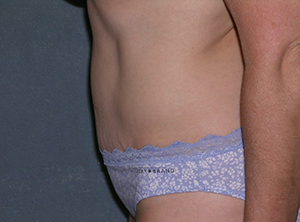 Tummy Tuck Before and After Photos