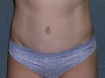 Tummy Tuck