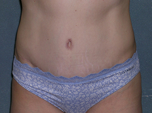 Tummy Tuck Before and After Photos