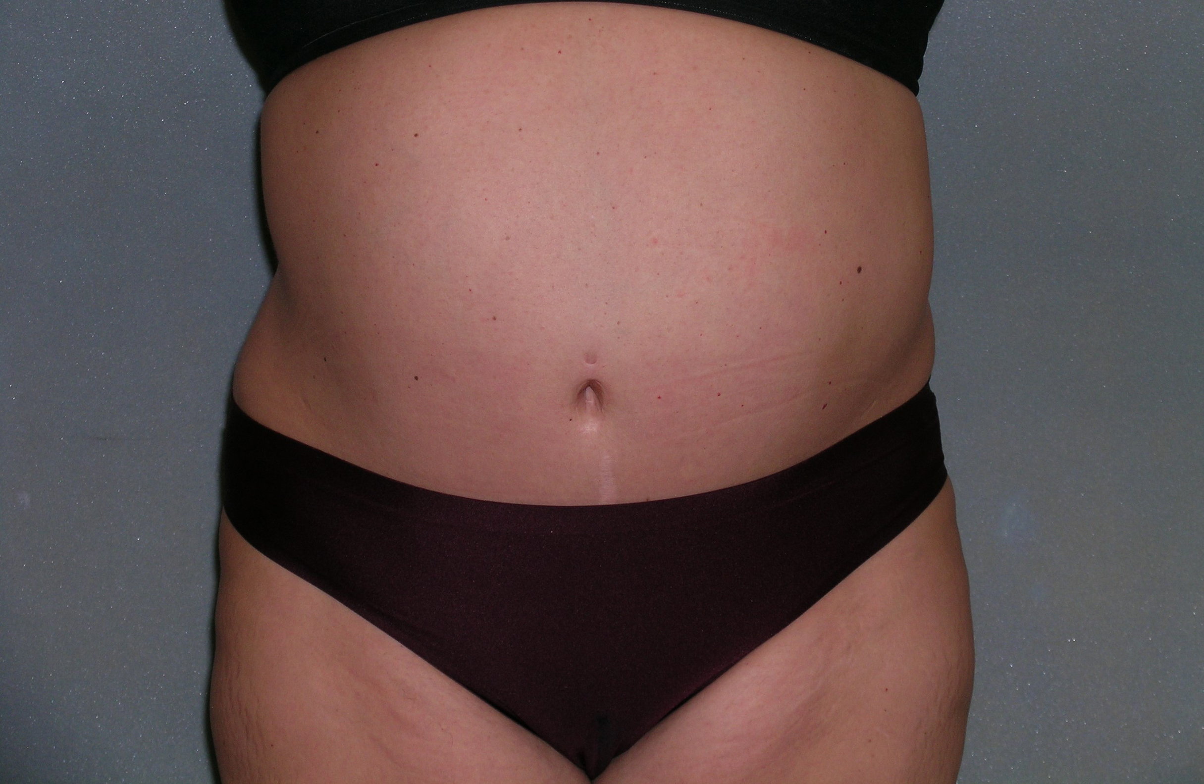 Body Liposculpture Before and After Photos