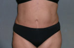 Body Liposculpture