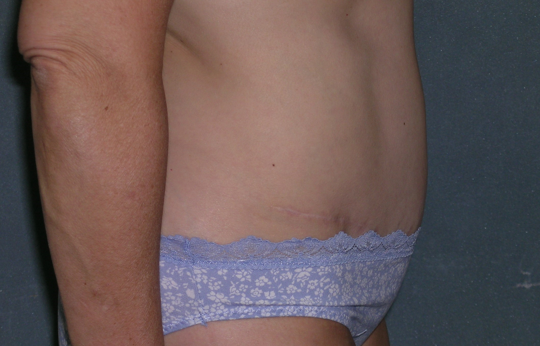 Mommy Makeover Before and After Photos Mommy Makeover Before and After Photos