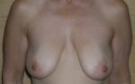 Mastopexy Augmentation