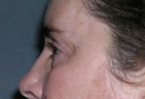 Blepharoplasty Case 5237 After Photo Blepharoplasty