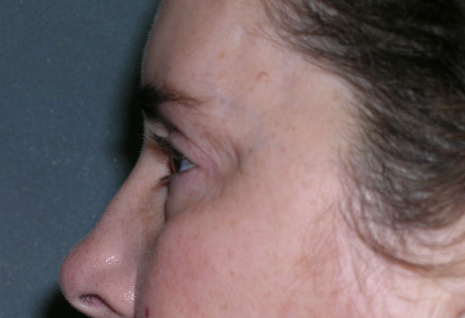 Blepharoplasty Before and After Photos