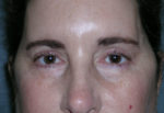 Blepharoplasty