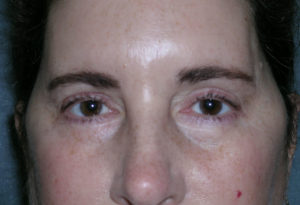 Blepharoplasty Case 5237 After Photo Blepharoplasty