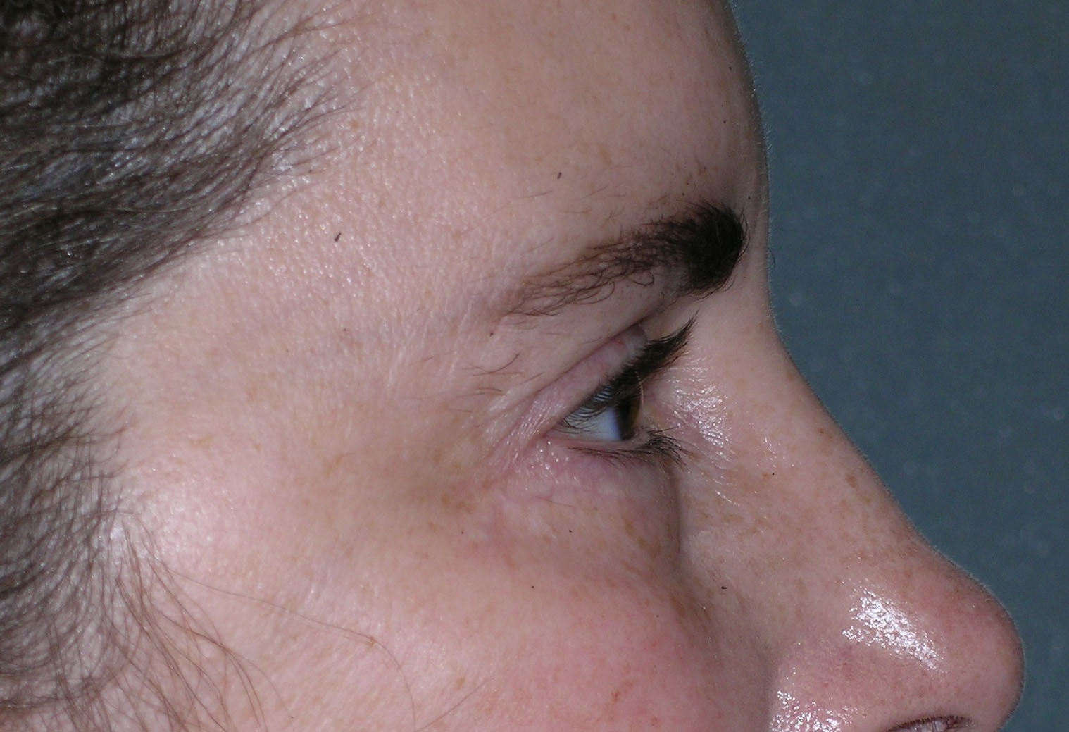 Blepharoplasty Before and After Photos