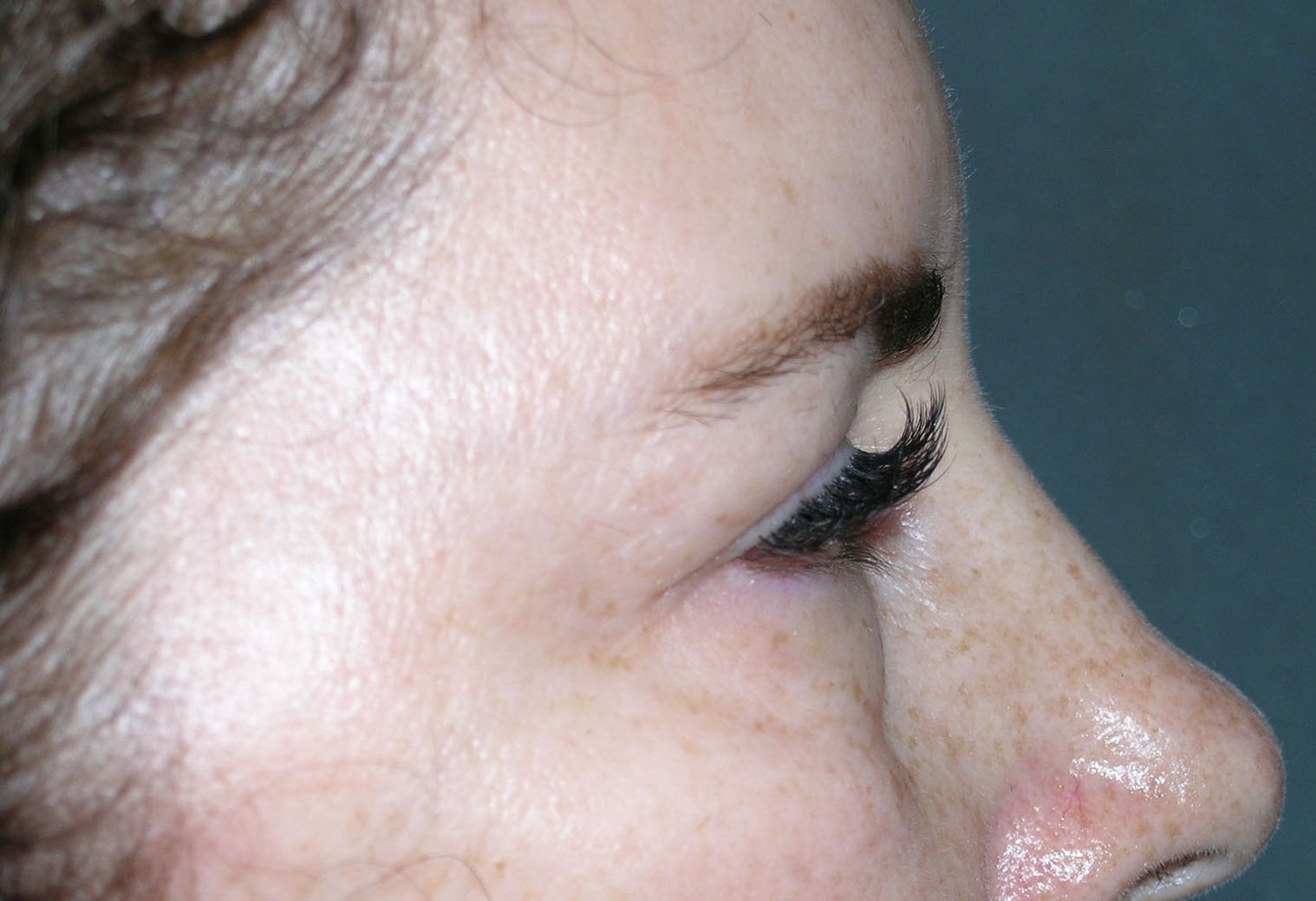 Blepharoplasty Before and After Photos