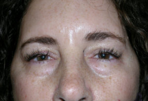 Blepharoplasty Case 5237 Before Photo Blepharoplasty
