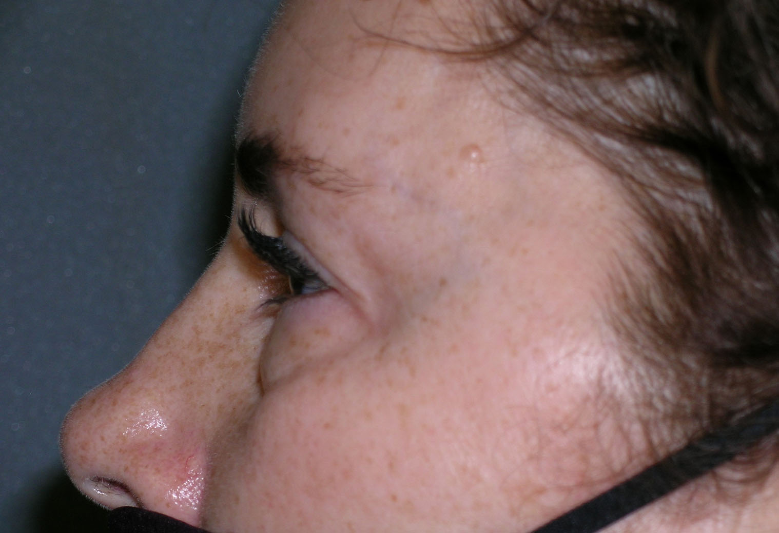 Blepharoplasty Before and After Photos