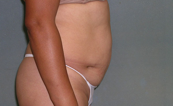 Tummy Tuck Before and After Photos