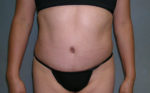 Tummy Tuck