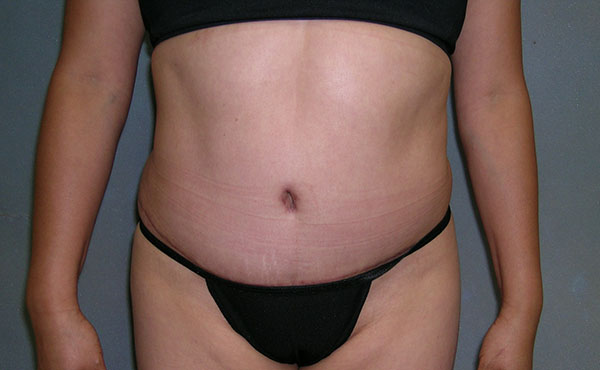 Tummy Tuck Before and After Photos