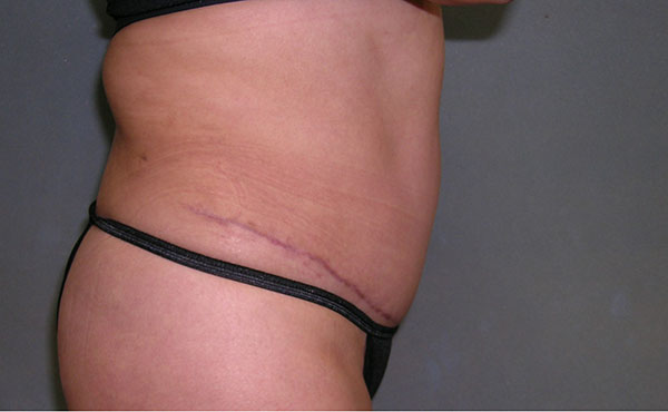 Tummy Tuck Before and After Photos