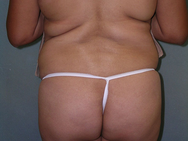 Tummy Tuck Before and After Photos