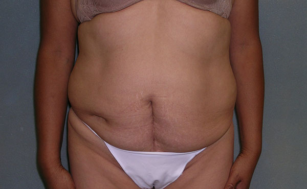 Tummy Tuck Before and After Photos