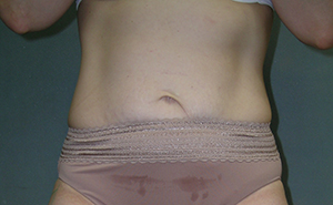 Tummy Tuck Before and After Photos