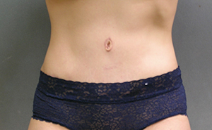 Tummy Tuck Before and After Photos