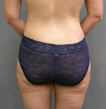 Body Liposculpture